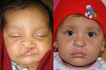 cleft lip surgery for children doctor jacono