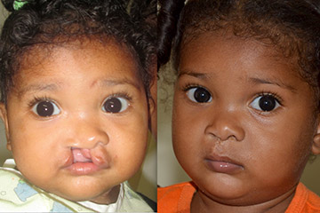 cleft lip surgery for children dr jacono nyc