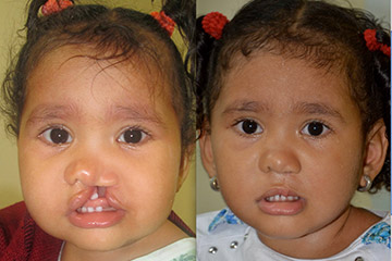 surgery plastic children before face ugly facial fix york surgeon