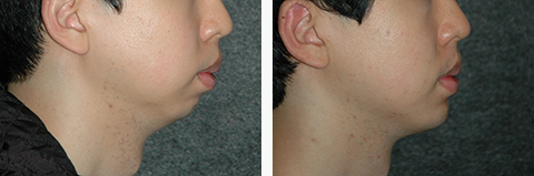 Asian Chin Implant Photos