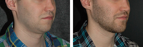 Chin Augmentation New York City