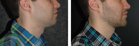 Chin Augmentation New York