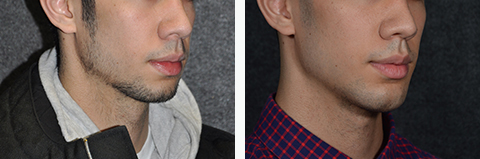 Chin Augmentation Patient Before and After