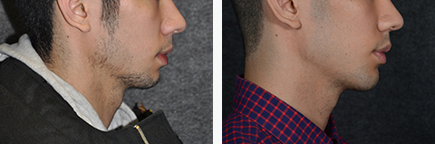 Chin Augmentation Patient Photos