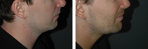 Chin Implant Before and After Photos