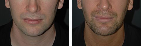 male jaw implant before and after