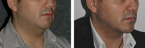 Male Chin Augmentation Photos