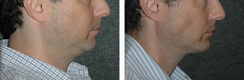 Male Chin Augmentation Pictures