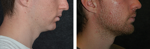 Male Chin Implant Photos