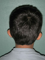 Otoplasty - Patient 3 - Back - Before