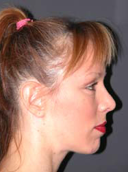 Mid Facelift - Patient 6 - Lateral Right - After