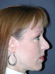 Mid Facelift - Patient 6 - Lateral Right - Before