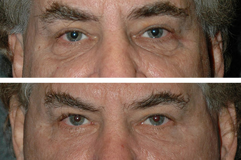 Best Lower Eyelid Surgery for Men