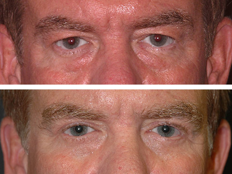 Male Blepharoplasty Photos