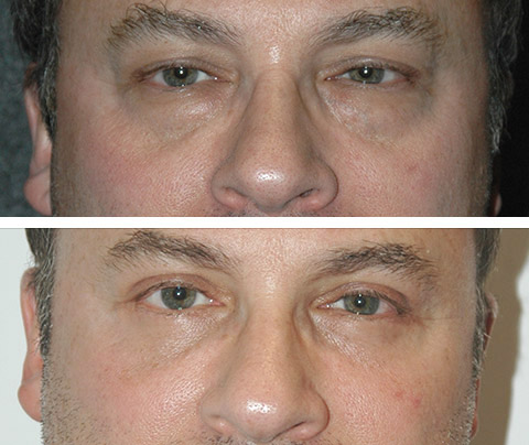 Male Blepharoplasty New York NY   Male Eyelid Surgery Patient Before And After Photos 