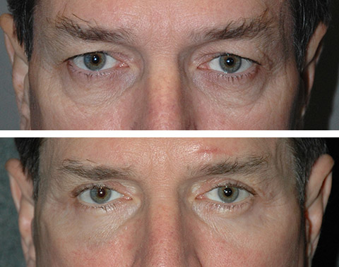 lower blepharoplasty gone wrong