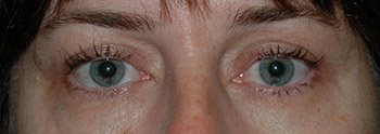 upper eyelid surgery patient pics