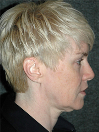 Facelift - Patient 1 - Lateral Right - Before Facelift - Patient 1 - Lateral Right - Before