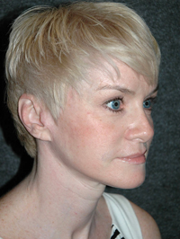 Facelift - Patient 1 - Obl Right - After Facelift - Patient 1 - Obl Right - After