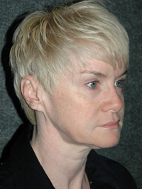 Facelift - Patient 1 - Obl Right - Before Facelift - Patient 1 - Obl Right - Before