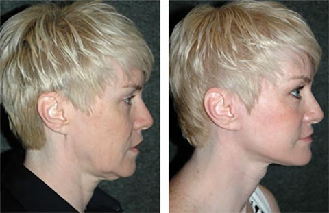 best facelift surgeon in the america