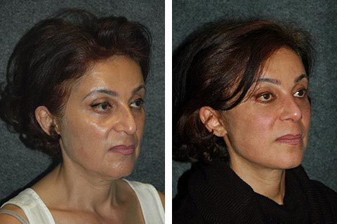 miglior chirurgo facelift in medio oriente dr jacono