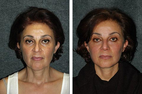 best facelift surgeon in the middle east