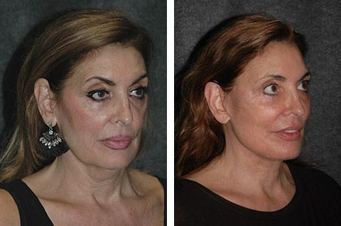 best facelift surgeon in the world after results