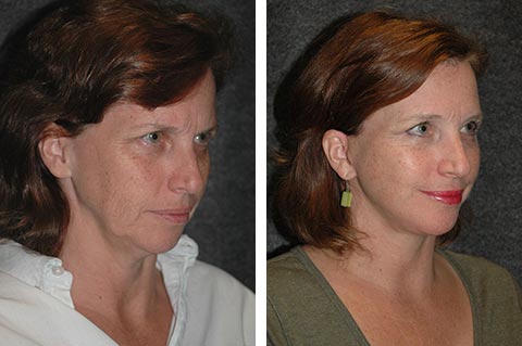 best facelift surgeon in the world photos