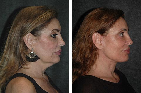 best facelift surgeon in the world results