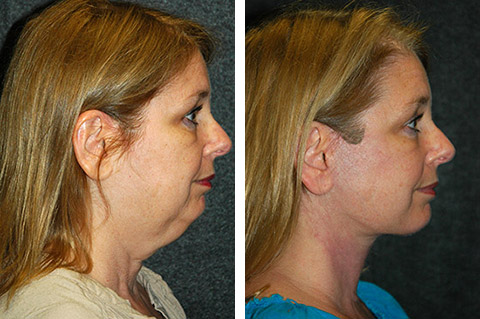 Why do facelifts cost more in different regions?