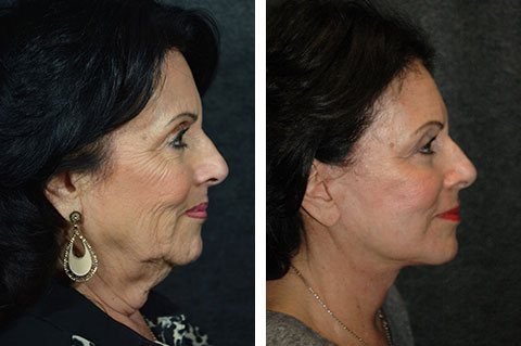 new york facelift patient before after photos new york facelift patient before after photos
