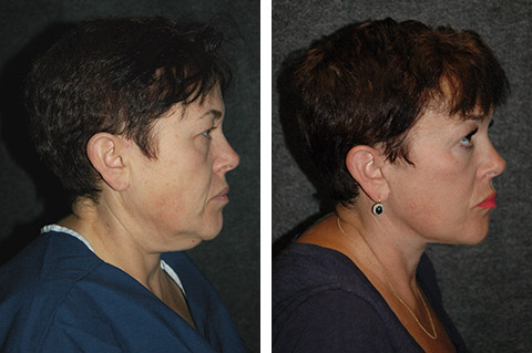 new york facelift patient before and after