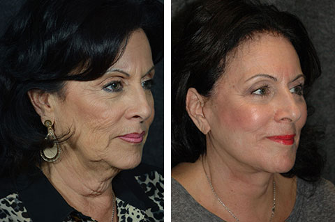 new york facelift patient photos new york facelift patient photos