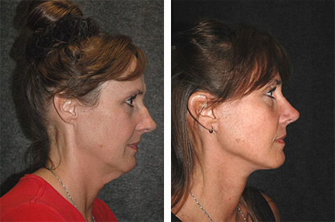 new york facelift specialist new york facelift specialist
