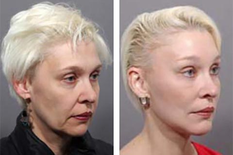 Worlds best facelift surgeon photos