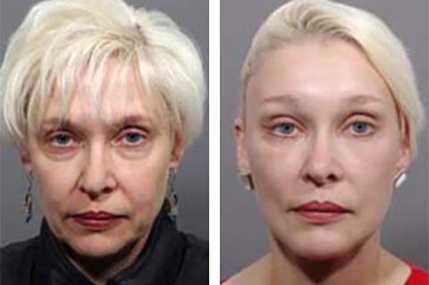 facelift surgeon before after worlds usa