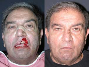 MOHS FACIAL RECONSTRUCTION - Patient 24