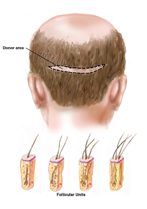 Hair Transplants NYC