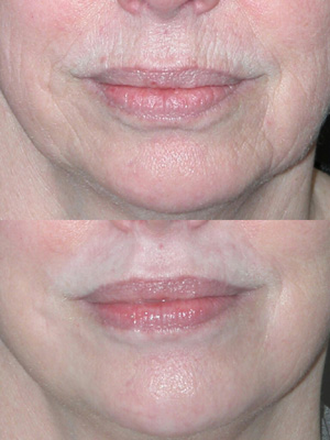 how scars cover makeup with New Peels NY  York, Skin