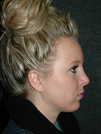 Rhinoplasty - Patient - Lateral Right - After