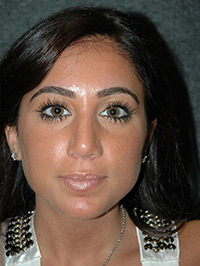 Rhinoplasty - Patient - Front - After