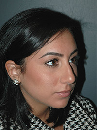 Rhinoplasty - Patient - Obl Right - Before