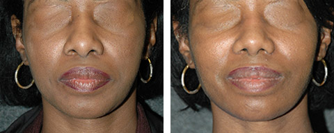 african american rhinoplasty before after photos