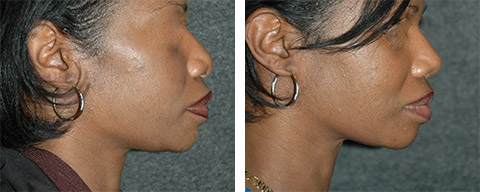 african american rhinoplasty patient photos