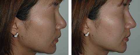 asian non surgical rhinoplasty before and after photos nyc