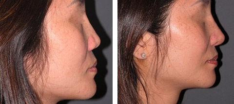 asian rhinoplasty before and after photos nyc