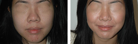 asian rhinoplasty before and after photos