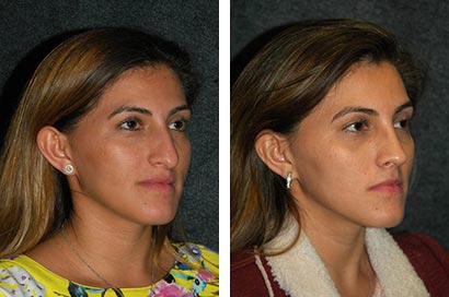 Before and After Closed Rhinoplasty Photos