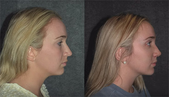 Rhinoplasty Recovery Rhinoplasty Recovery Tips New York 